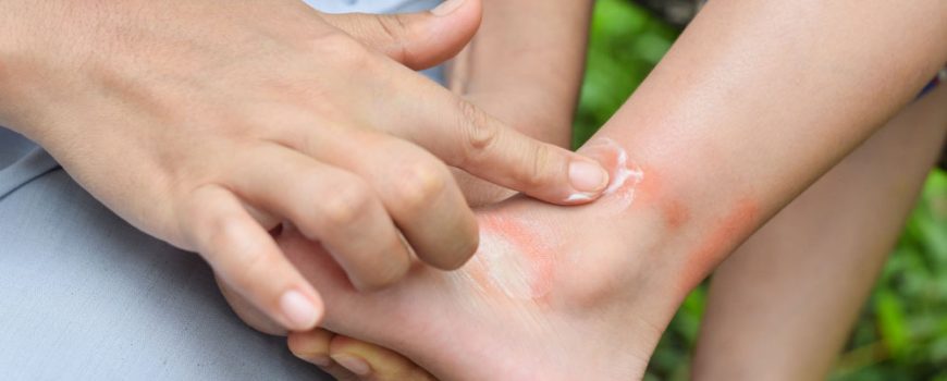 Everything You Need to Know About Insect Stings and Bites